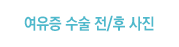 여유증 수술 전/후 사진